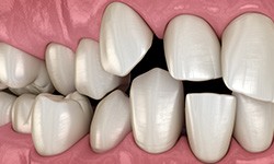 Illustration of spaced-out teeth