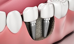 Dental implants in Middleburg Heights, OH in jawbone