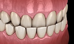 Illustration of an underbite