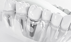 Dental implant in Middleburg Heights, OH in plastic model of mouth